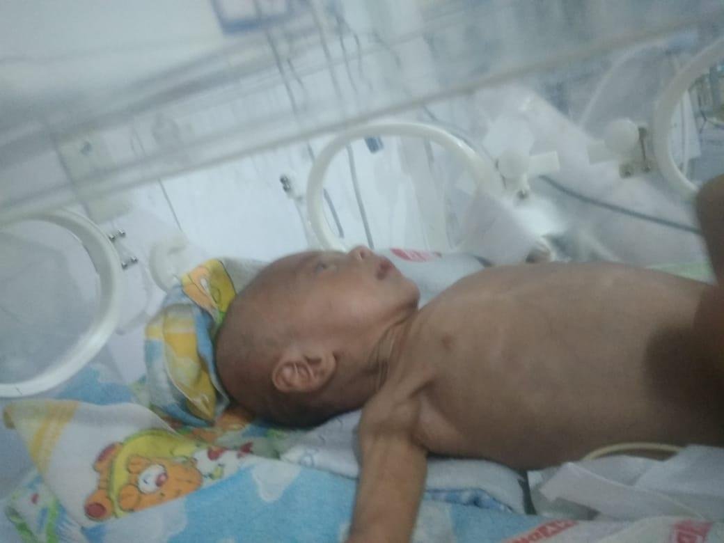 Seorang balita warga Kelurahan Kandang, Kecamatan Kampung Melayu, Kota Bengkulu, diduga mengalami gizi buruk dan stunting. Balita ini sangat membutuhkan bantuan dari pemerintah setempat agar kondisi kesehatannya kembali normal seperti balita lainnya.(Foto HB/Idris)